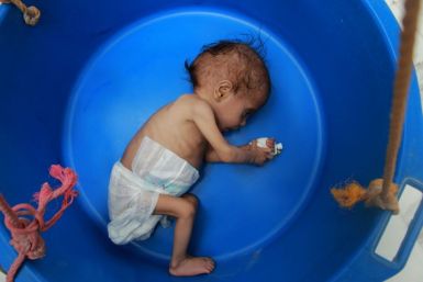 A Yemeni child suffering from malnutrition is weighed at a treatment centre in northern Hajjah province