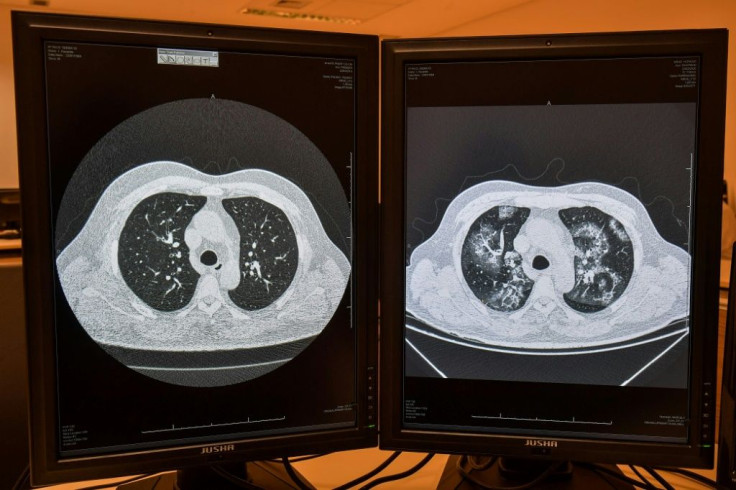 A tomography image of the same patient showing a healthy lungs (L) and lungs affected by COVID-19 (R) at the University of Sao Paulo Clinical Hospital