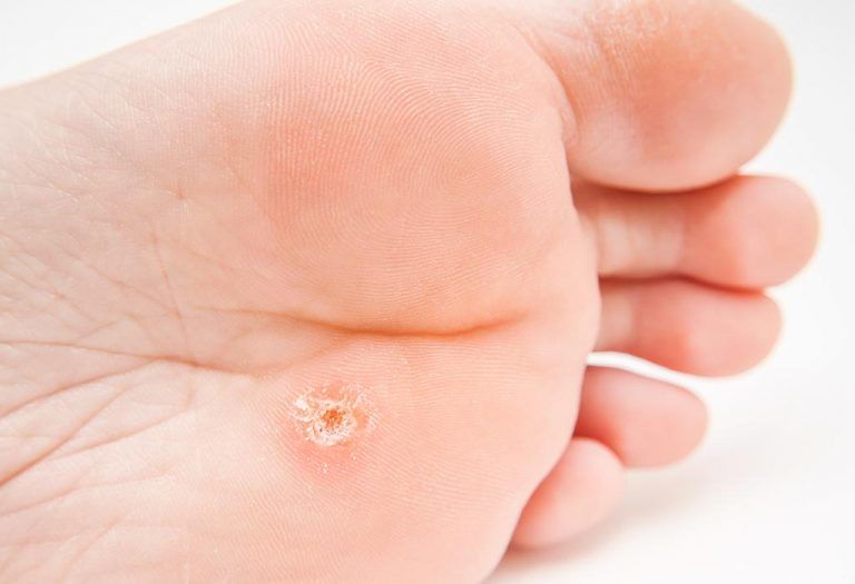 10 Corn, Callus Removal Pads IBTimes