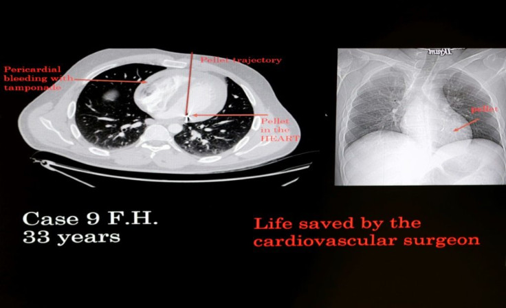 Computer tomography of a patient whose heart who was hit by small lead pellets fired by security forces