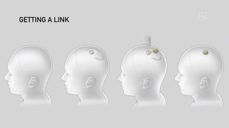 This video grab made from the online Neuralink livestream shows a drawing of the different steps of the implantation of a Neuralink device seen during a presentation on August 28, 2020