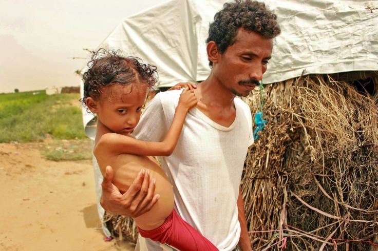 A displaced Yemeni eight-year-old girl,  Samar Ali Ahmed, who weighs nine and a half kilograms and suffers from acute malnutrition, in northern Yemen