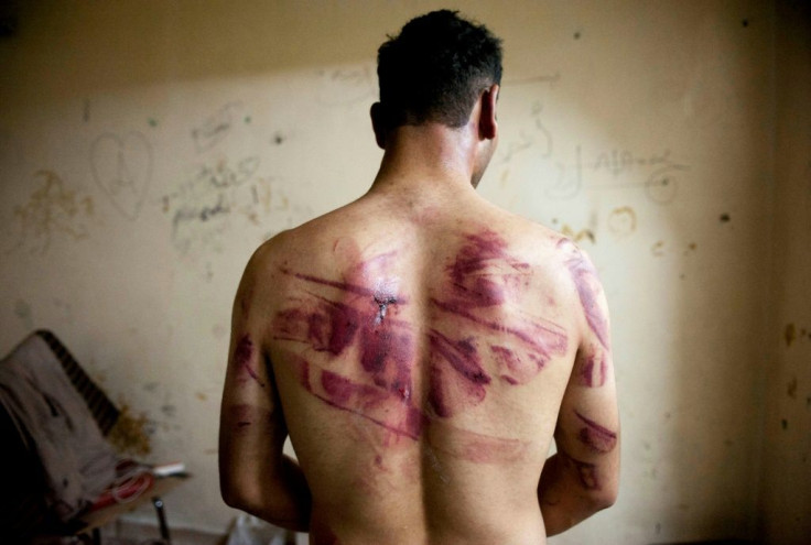 A Syrian man shows torture marks on his back after he was released from regime forces in the northern city of Aleppo
