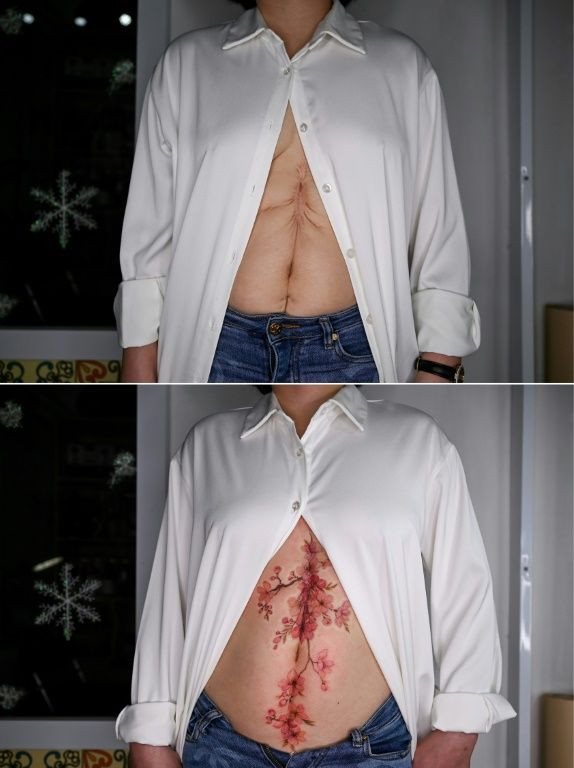 Huong -- not her real name --Â has felt ashamed of her body since appendicitis surgery 14 years ago left her with an "ugly" vertical scar