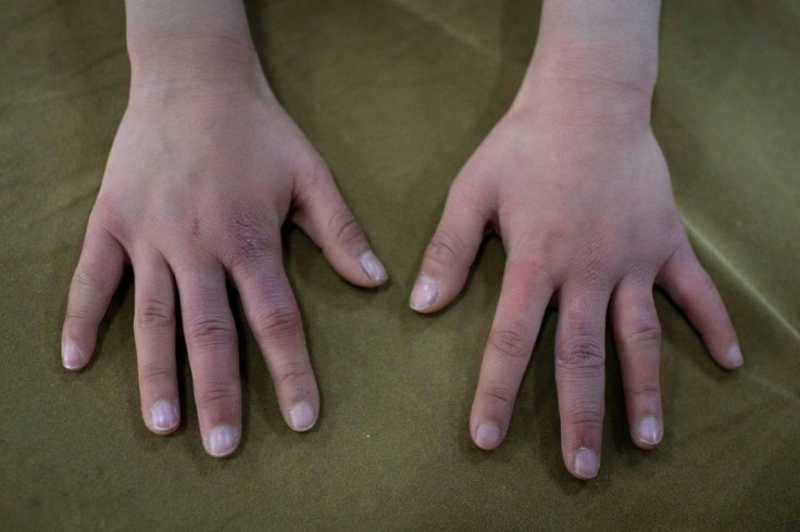 Young gymnast Du Xiyun shows her hands after a day of training at the Li Xiaoshuang Gymnastics School