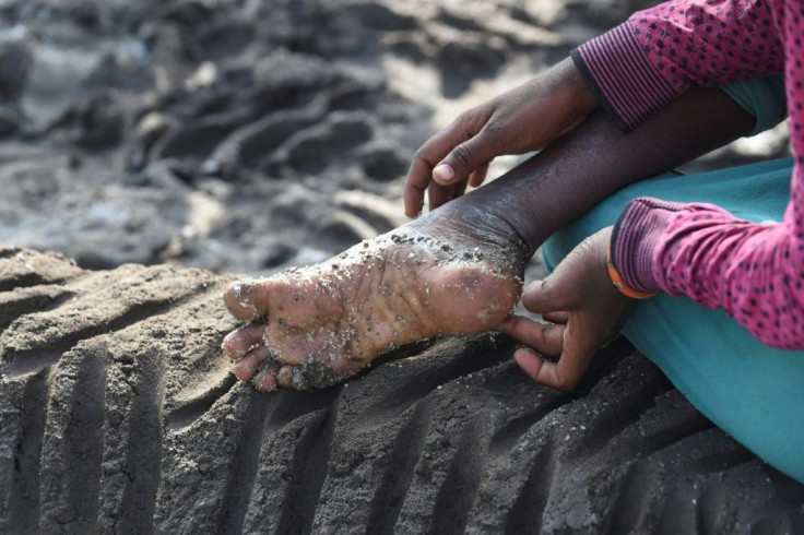 The work is both tedious and taxing, and leaves farmers vulnerable to painful foot infections