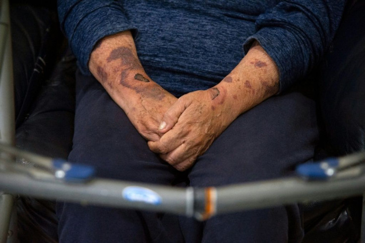 Marisela Oliva has bruises on her arms and uses a walking frame because of abuse by her ex-partner