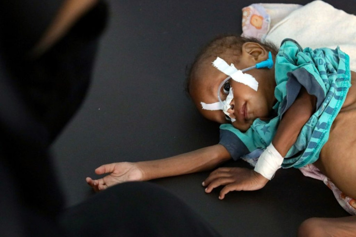 A child receives treatment at a malnutrition center in Taez in an image taken on July 3