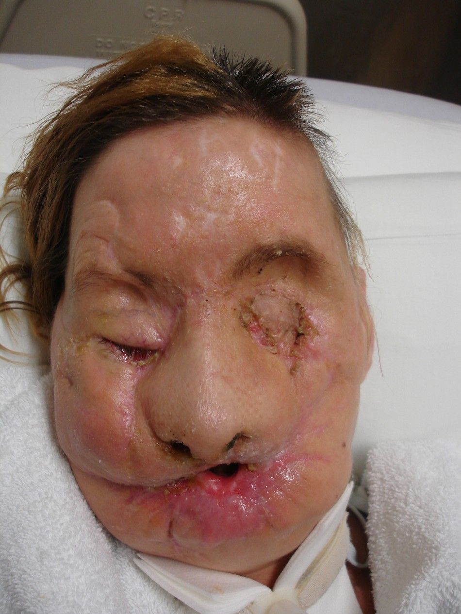 Face transplant recipient Charla Nash is pictured after her injury, in this undated photograph released on June 10, 2011.