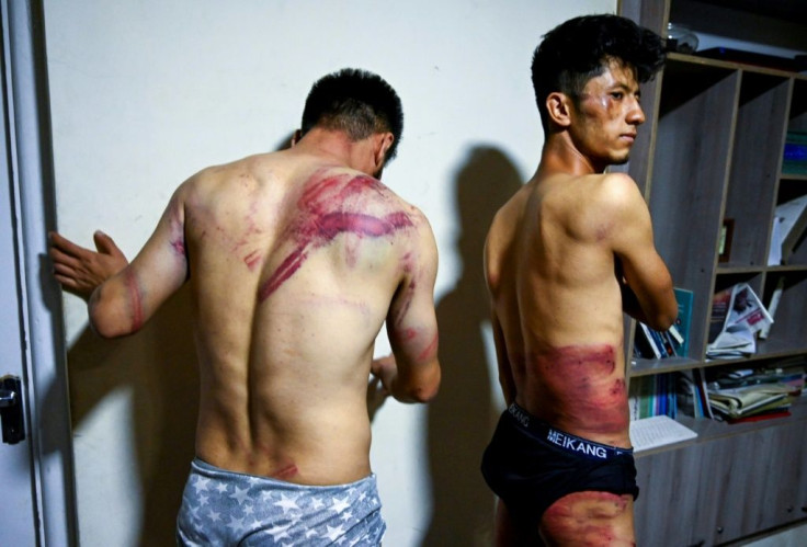 Afghan journalists Nematullah Naqdi and Taqi Daryabi show their wounds after being released from Taliban custody