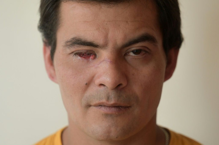 Luis Rodriguez Mojica, 35, lost an eye in an attack by assailants wielding an immitation gun