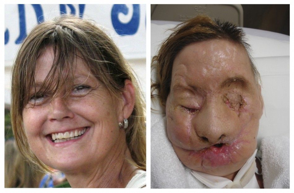 A combination photo shows face transplant recipient Charla Nash, of Stamford, Connecticut, before L and after her injury, in these undated photographs released on June 10, 2011.