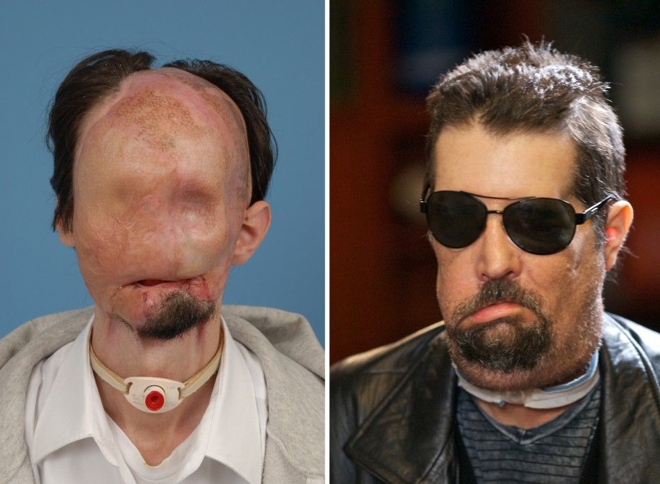 Face transplant patient Dallas Wiens is seen before L his transplant and after R in this combination handout image released to Reuters on May 9, 2011.