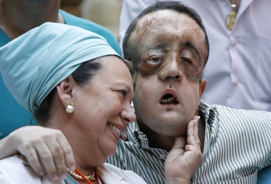 Face transplant recipient Rafael embraces a nurse during a news conference at Virgen del Rocio hospital in Seville