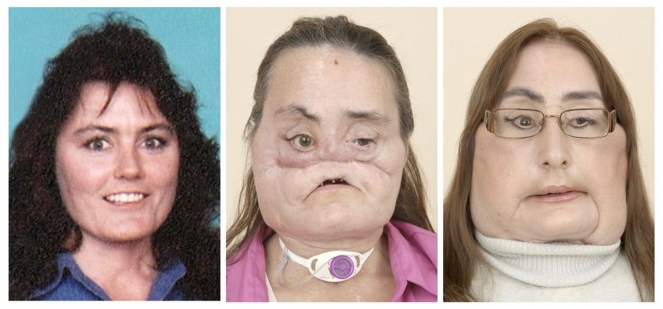 Face transplant patient Connie Culp is seen in this combination photo made of handouts released to Reuters by Cleveland Clinic on May 6, 2009.