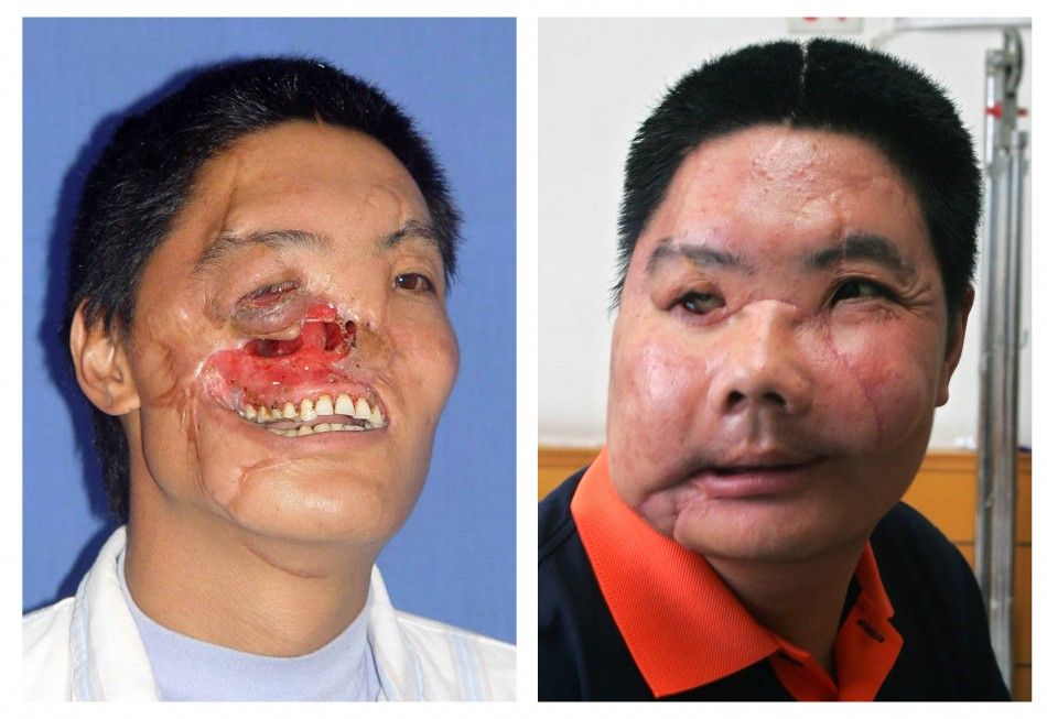 A combination photograph shows a man before and after his operation when he received a face transplant, in Xian, Shaanzi province.