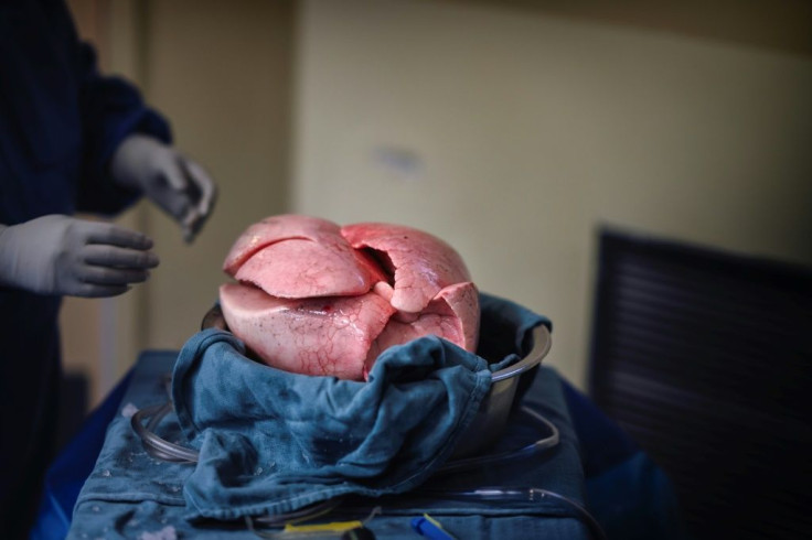Two days after receiving transplant lungs delivered by drone, seen in this handout photo released by Unither Bioelectronique and taken in September 2021, the Toronto General Hospital patient was well enough to virtually attend his daughter's wedding