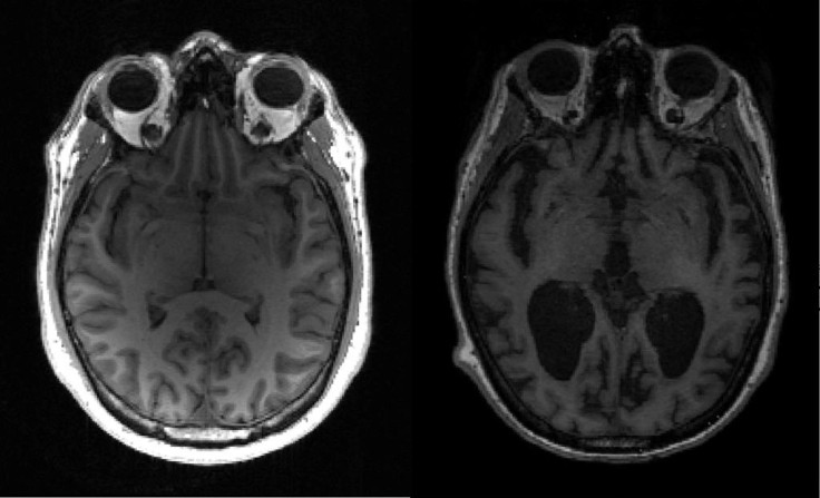 An MRI image of a healthy brain (L) and an Alzheimer's brain (R) with large black gaps where brain has shrunk