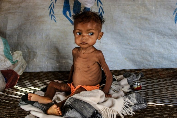Randa, a Yemeni baby suffering from severe malnutrition, awaits treatment a centre run by a humanitarian organisation, inside a camp for the displaced who fled fighting between Huthi rebels and the Saudi-backed government, in the Abs district of the north
