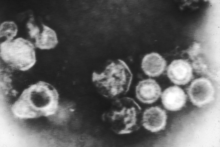 Epstein-Barr Virus (EBV)