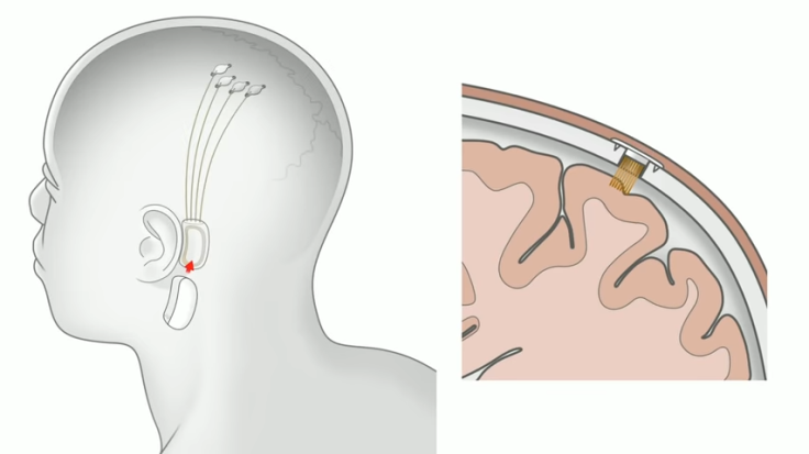 Neuralink Launch Event 