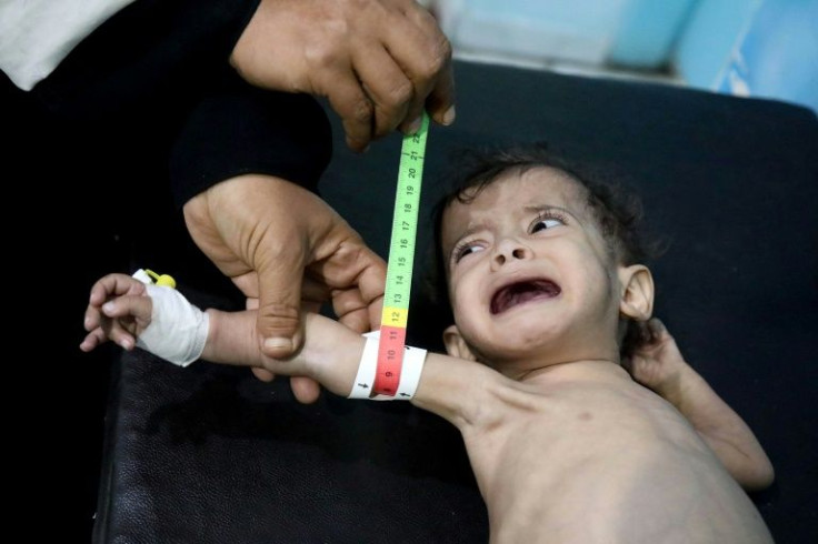 A malnourished child receives treatment in Yemen's third city of Taez, on March 6, 2022