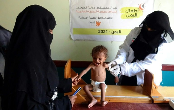 In this photo taken on August 7, 2021, a health worker measures a malnourished child at a clinic in the province of Hodeida. The WFP has said levels of hunger in Yemen could become catastrophic if the Ukraine crisis pushes up food prices