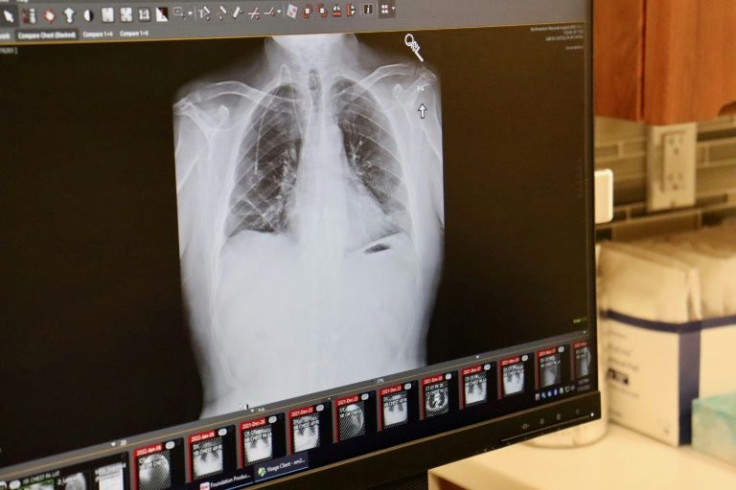 In this January 12, 2022, handout image courtesy of Northwestern Medicine, a computer screen displays an X-Ray of Albert Khoury's new lungs at Northwestern Medicine in Chicago.
