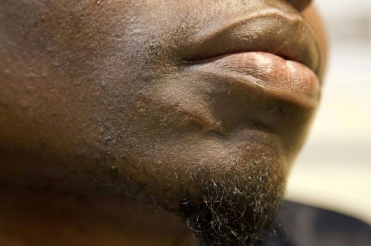 The bodies of some migrants bear evidence of abuse from their time in Libya