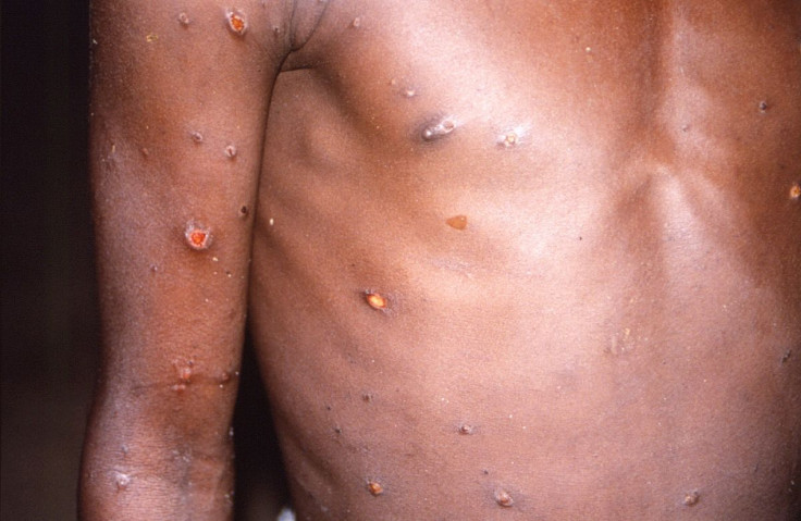 An image created during an investigation into an outbreak of monkeypox, which took place in the Democratic Republic of the Congo, 1996 to 1997, shows the arms and torso of a patient with skin lesions due to monkeypox, in this undated image obtained by Reu
