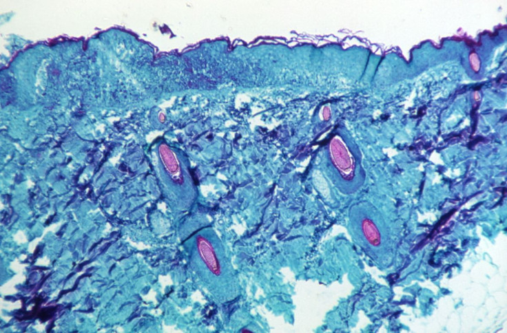 FILE PHOTO - A section of skin tissue, harvested from a lesion on the skin of a monkey, that had been infected with monkeypox virus, is seen at 50X magnification on day four of rash development in 1968. CDC/Handout via REUTERS.