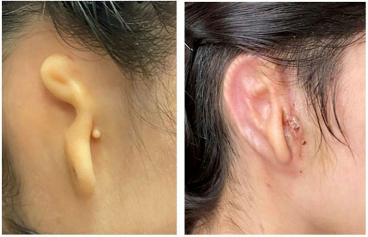 This May 31, 2022, image courtesy of Dr. Arturo Bonilla of the Congenital Ear Institute in San Antonio, Texas, shows a before (L) image of a patient's ear and an image 30 days after surgery to reconstruct the ear lobe