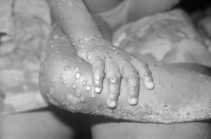 Monkeypox Lesions