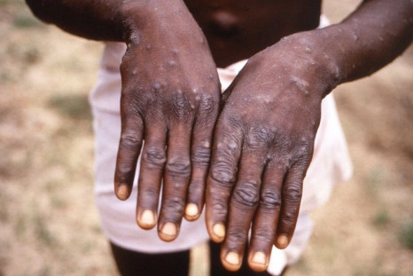 Initial symptoms of monkeypox include a high fever, swollen lymph nodes and a blistery chickenpox-like rash