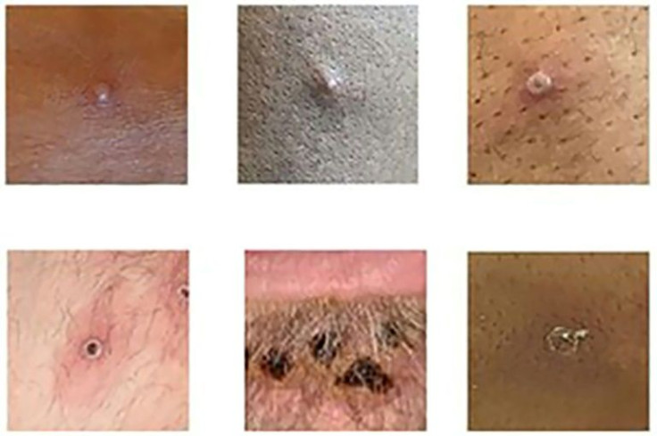 A picture made available by the UK Health Security Agency showing a range of monkeypox lesions