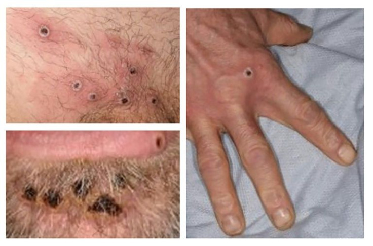 Most of the new monkeypox cases have been recorded in Europe