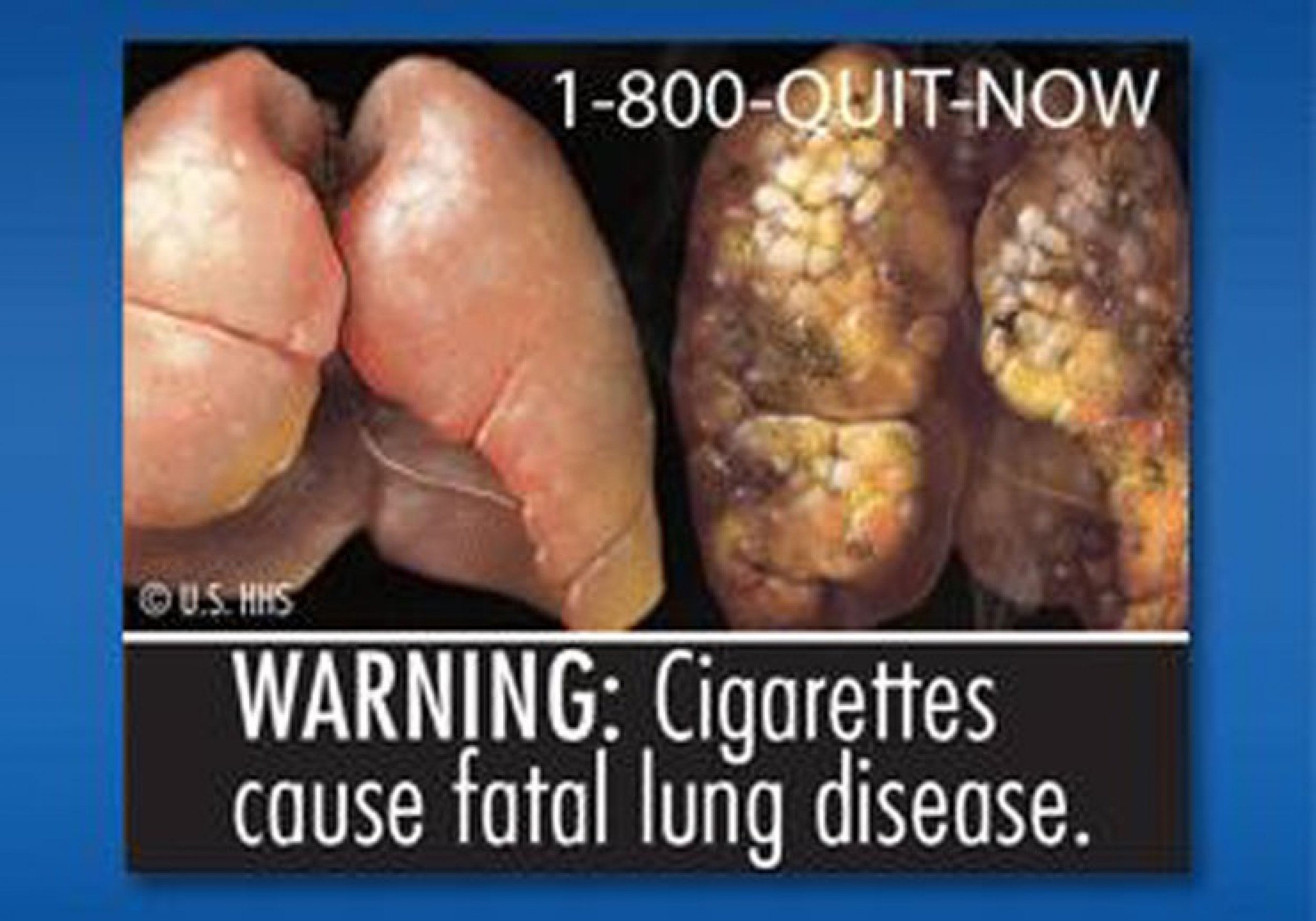 Graphic Images of FDAs Cigarette Health Warnings PHOTOS