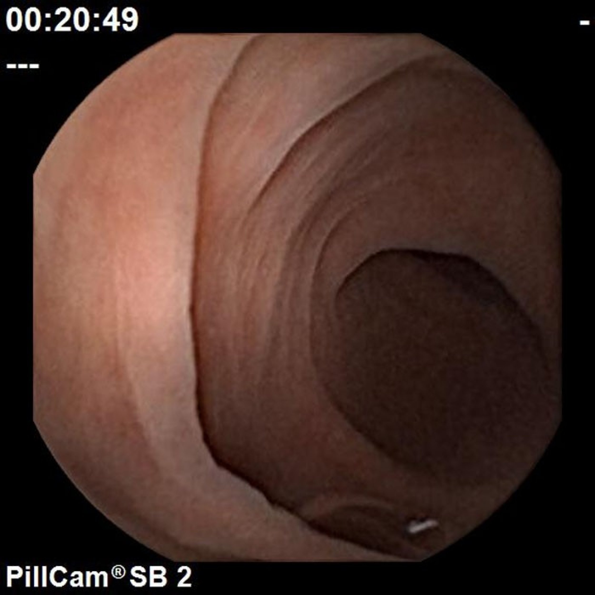 An image taken by pill-size remote-controlled endoscope Mermaid inside the human digestive tract