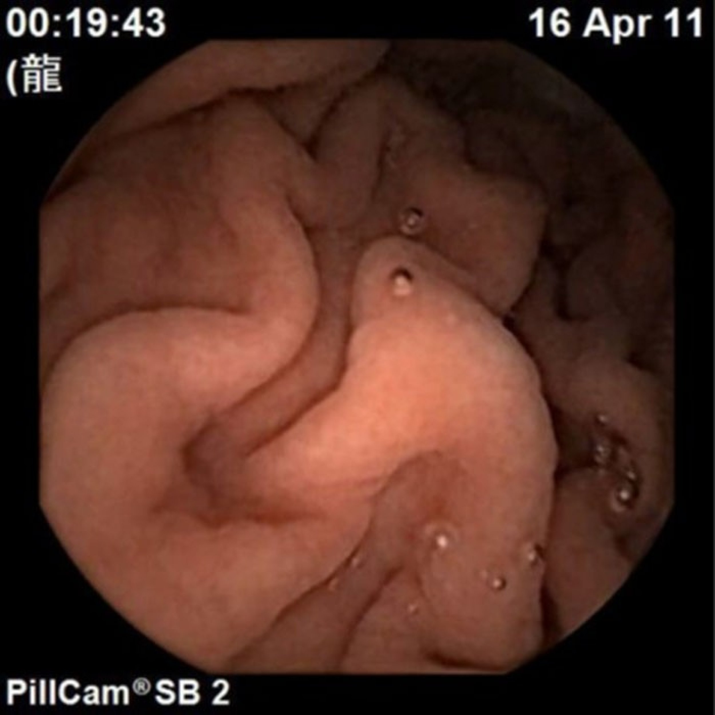 An image taken by pill-size remote-controlled endoscope Mermaid inside the human digestive tract