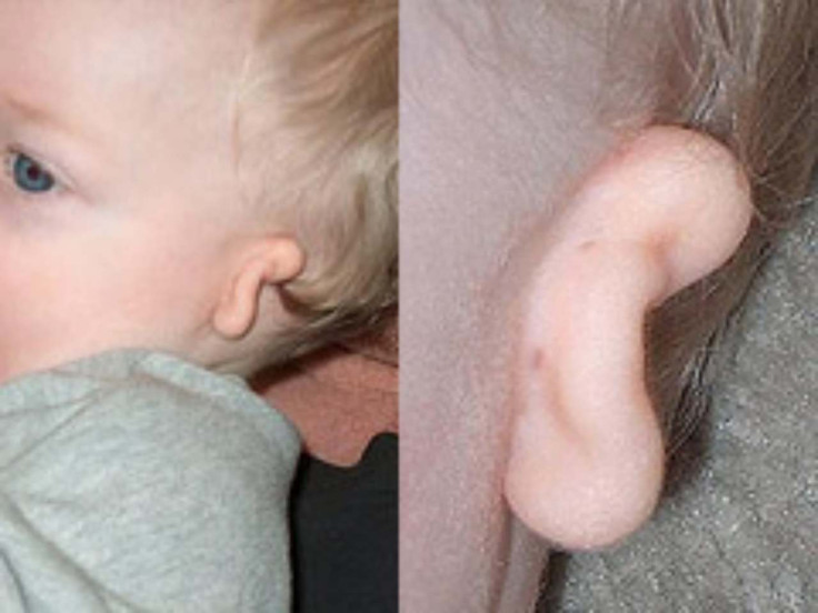Microtia, ear condition, 