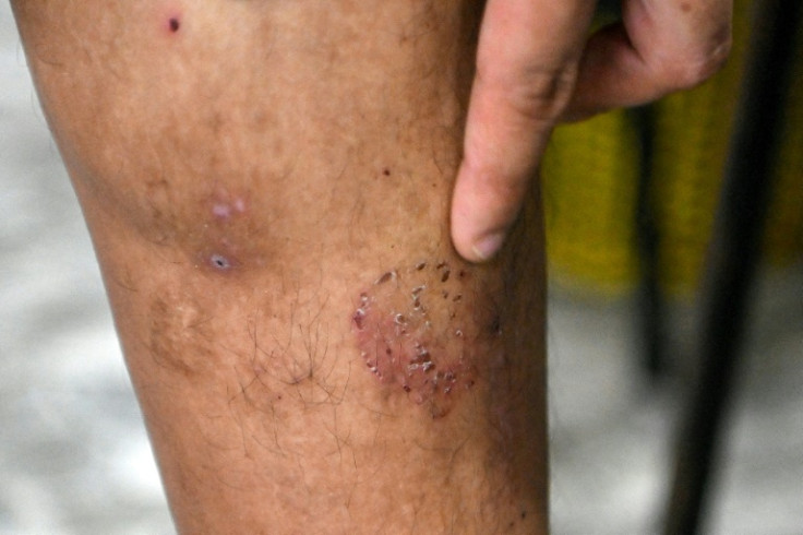 A victim of a Chinese scamming gang shows a scar on his leg after he was tortured