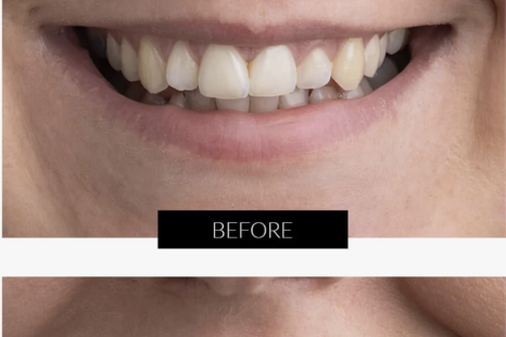 LED Teeth Whitening