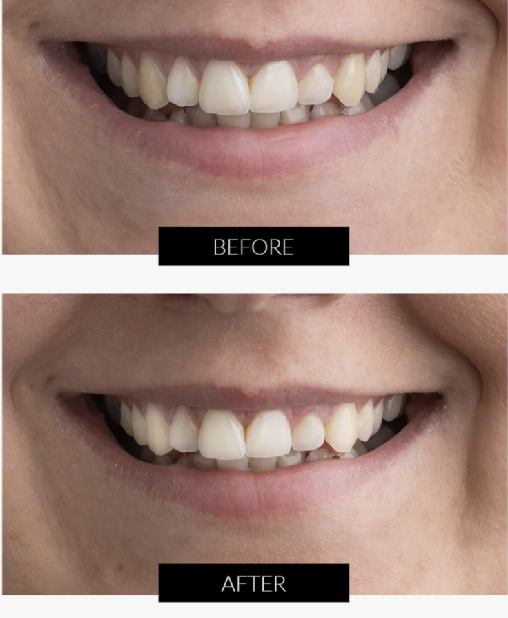 LED Teeth Whitening