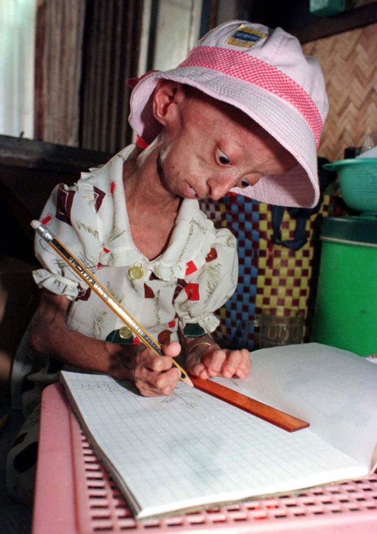 Nguyen Thi Ngoc, 13, practices her writing at home in Ho Chi Minh City. Ngoc is Vietnam's first known case of Hutchinson-Gilford Progeria Syndrome, a rare disease which ages the body so rapidly its victims die before they have barely experienced yout