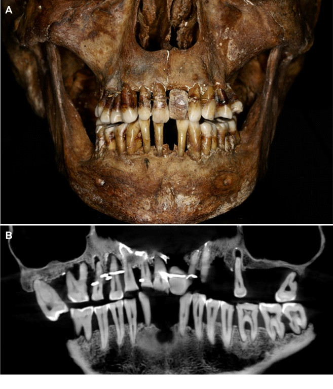 The teeth of 17th century French aristocrat Anne d'Alegre, with a gold wire threading through several