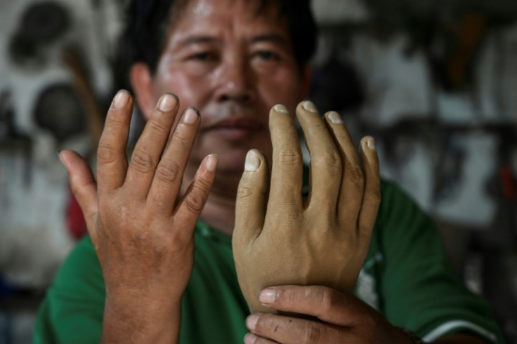Former leprosy patient Ali Saga makes prosthetic limbs for residents of Indonesia's Sitanala village, where hundreds of former patients live