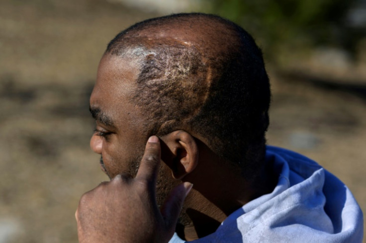 Community activist and gun violence survivor Oronde McClain, who was shot in the back of the head at 10 years old, points at his scar in Philadelphia, Pennsylvania on March 16, 2023