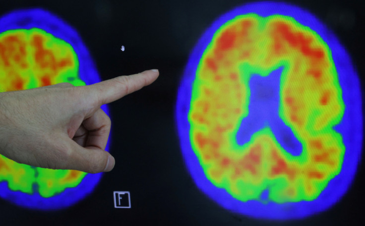 Evidence of Alzheimer’s disease on PET scans at the Center for Alzheimer Research and Treatment in Boston