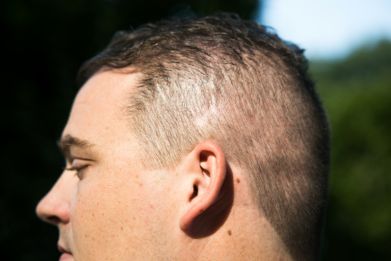 The scar above Burkhart's ear, where the device was previously screwed in. 'Your scalp is trying to close the whole time,' he said
