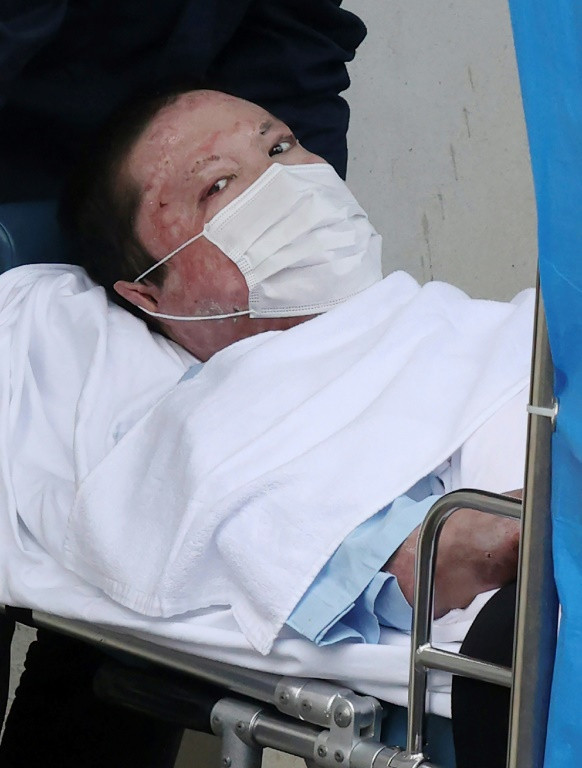 Alleged arsonist Shinji Aoba sustained burns over more than 90 percent of his body